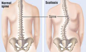 cum se tratează osteoporoza articulațiilor artroza internă a genunchiului