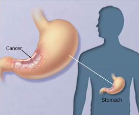 Image result for ulcer ne stomak